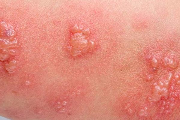 Έρπης-ζωστήρ-ΣΜΝ-παθολόγος-έρπητας-κονδυλώματα-hpv-vzv